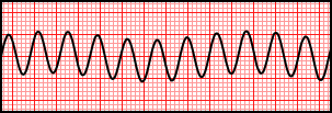 Ventricular Flutter.svg