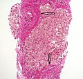 Histopathology of steatohepatitis with established cirrhosis, with thick bands of fibrosis (Van Gieson's stain)[95]