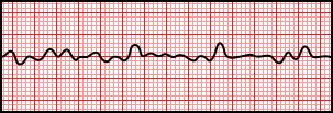 Ventricular Fibrillation.svg