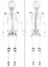 Skelettszintigrafien bei zwei Kindern, links 7 Jahre, rechts 15 Jahre alt (nicht maßstabsgerecht). Jeweils intensiver Knochenstoffwechsel in den Wachstumsfugen.