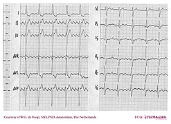 DVA0232 (CardioNetworks ECGpedia).jpg