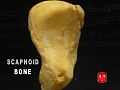 Scaphoid bone.
