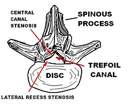 Description de l'image LUMBAR TREFOIL CANAL.JPG.