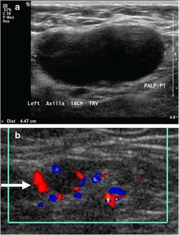 Medical ultrasonography of a soft tissue lump, showing signs of a suspected malignant lymph node:[15] - Doppler ultrasonography that shows hyperaemic blood flow in the hilum and central cortex and/or abnormal (non-hilar cortical) blood flow - Increased focal cortical thickness greater than 3 mm - Absence of the fatty hilum