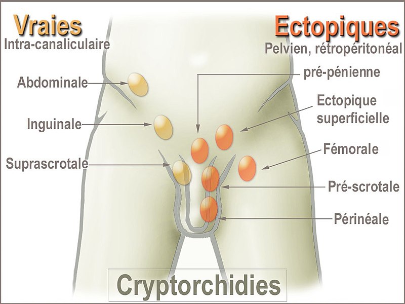 File:CryptorchidismForms.jpg