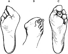 PSM V17 D759 Feet deformed by improperly shaped shoes.jpg