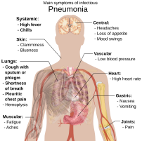 Main symptoms of infectious pneumonia