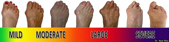 Bunion Progression Scale.jpg