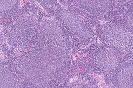 Biopt van folliculair lymfoom (H&E-kleuring)