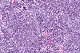 Description de l'image Follicular lymphoma -- low mag.jpg.