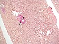 No fibrosis, but mild zone 3 steatosis, in which collagen fibres (pink–red, arrow) are confined to portal tracts (P) (Van Gieson's stain)[95]