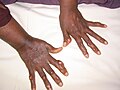 February 17: A patient's hands with multiple xanthomas.