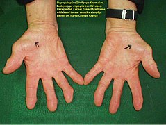 Carpal Tunnel Syndrome, thenar atrophy.jpg