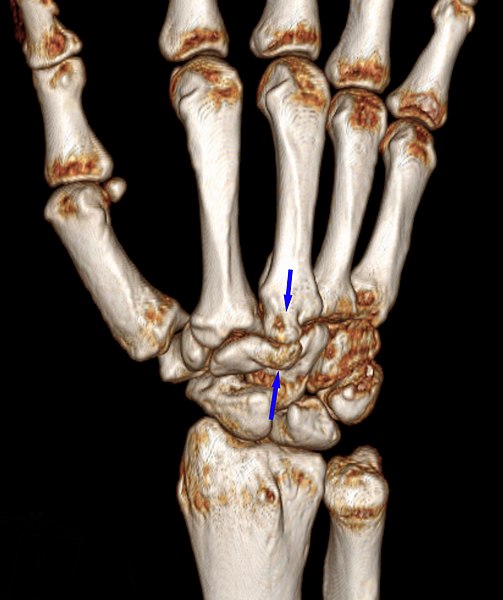 File:Carpal-boss-3d.jpg