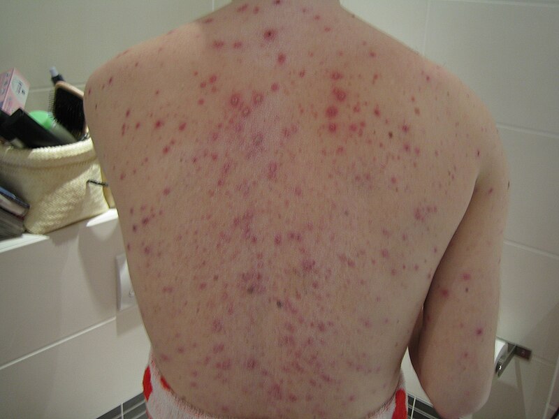 File:Adult back with chickenpox.jpg