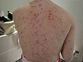 Man with chickenpox