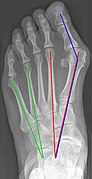 Hallux valgus Normwerte (only X-ray).jpg