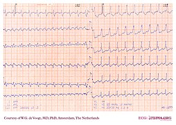 DVA0210 (CardioNetworks ECGpedia).jpg