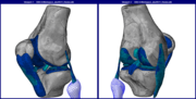 Metoda konečných prvků - kolenní kloub (Articulatio genus) člověka