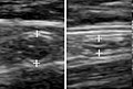 A normal appendix without and with compression. Absence of compressibility indicates appendicitis.[57]