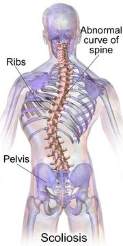 Blausen 0785 Scoliosis 01.png