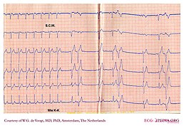 DVA0328 (CardioNetworks ECGpedia).jpg