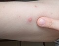 Chickenpox blister