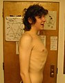 Pectus carinatum