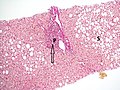 Histopathology of steatohepatitis with mild fibrosis in the form of fibrous expansion (Van Gieson's stain)[95]