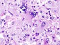 A pheochromocytoma showing finely granular chromatin. H&E stain.