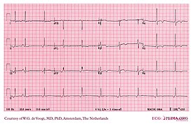 DVA0241 (CardioNetworks ECGpedia).jpg