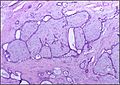 Histopatološki prikaz fibroadenoma dojke; proliferacija intralobularne strome, ki pritiska na epitelij, barvanje HE.