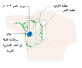 مرحلة 2B في سرطان الثدي