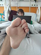 Hallux valgus, girl 13 years old, Czech Republic.jpg