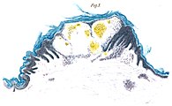Zeichnung nach einer Mikroskopbetrachtung einer Carminfärbung der Epidermis mit einem Angiokeratom, Aquarell aus Johannes Fabrys Artikel von 1898