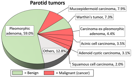 Relative incidence of parotid tumors, showing carcinoma ex pleomorphic adenoma at right.[3]