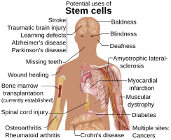 Diseases and conditions where stem cell treatment is promising or emerging. Bone marrow transplantation is, as of 2009, the only established use of stem cells