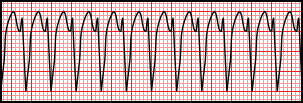 Ventricular Tachycardia.svg