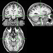 MRI scan of brain