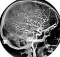 Normal carotidal arteriography