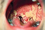 Thumbnail for Oral microbiology