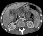 Tomodensitométrie montrant un cholangiocarcinome.