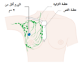 مرحلة 1A في سرطان الثدي