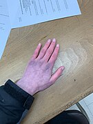 Hand of person with POTS dysautonomia.jpg