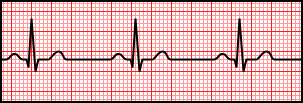 Sinus Bradycardia.svg