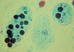 Entamoeba histolytica amb eritròcits fagocitats