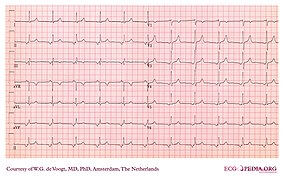 DVA0244 (CardioNetworks ECGpedia).jpg