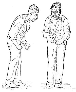 Two sketches (one from the front and one from the right side) of a man, with an expressionless face. He is stooped forward and is presumably having difficulty walking.