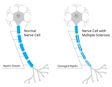 Myelin sheath damage in multiple sclerosis.svg