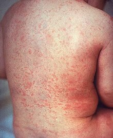 Rash of rubella on back (crop).JPG।